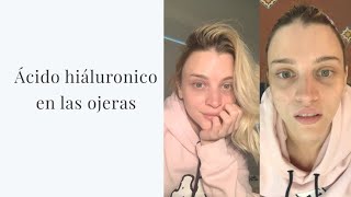 Me inyecto las ojeras con ácido hiáluronico [upl. by Asira]