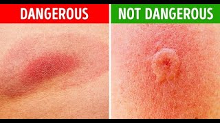 How to Identify Common Bug Bites [upl. by Essined]