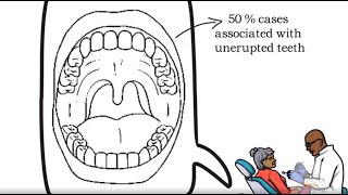 Calcifying Epithelial Odontogenic Tumor CEOT [upl. by Whall411]