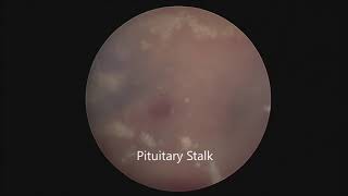 Transcortical Transventricular Cystic Craniopharyngioma [upl. by Jone]