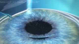 Cirurgia Refrativa a Laser Lasik para Miopia Astigmatismo e Hipermetropia [upl. by Rimma]