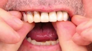 Partial Denture Video [upl. by Ashling]