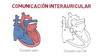 CIA  Comunicación interauricular [upl. by Flss]