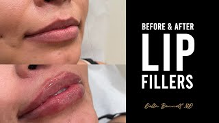 Juvederm Ultra Plus XC The Best Natural Looking Lip Filler by Christina RN 004 [upl. by Eldoree]