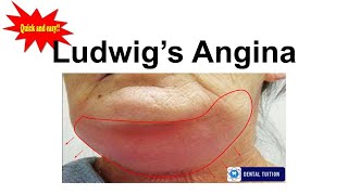 Ludwigs Angina in detail  Oral surgery General Surgery Dentalnotes [upl. by Argent197]