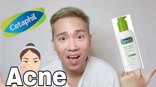 Cetaphil Daily Facial Moisturizer SPF 15 Review for Acne prone skin [upl. by Griseldis]