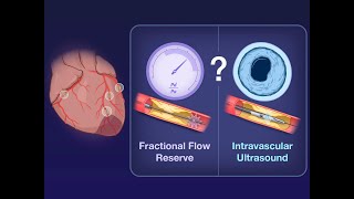 Adjunctive Tools to Guide PCI  NEJM [upl. by Ailecec]