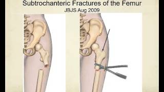 Proximal femur fractures how to identify and avoid malreduction malrotation [upl. by Roderic366]