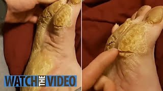 Removing Extremely Hard Foot Callus 🦶 The right way to remove foot callus FULL TREATMENT 08 [upl. by Llehsem]