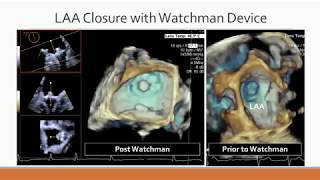 Watchman Implant Device for AFib [upl. by Anital]