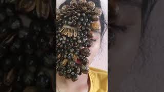 Removing Giant Blood Filled Ticks from Human Girl Face shorts ticks [upl. by Lakin]