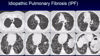 CHEST 2016 video sessions HRCT of the chest [upl. by Purse]