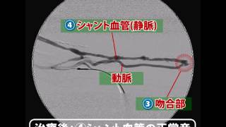 治療後：②シャント血管の正常音 [upl. by Aneej]