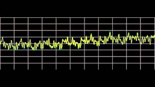 Osteoarthritis  Rife Frequencies [upl. by Moorefield]