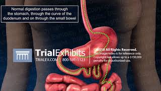 3D Medical Animation of Bowel Obstruction [upl. by Pigeon834]