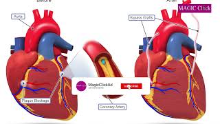 What is Coronary Artery Bypass Graft CABG surgery and care I Clerverscrubs [upl. by Bohlin]