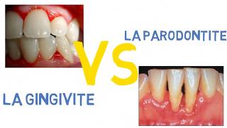 Gingivite VS parodontite [upl. by Werdnaed330]