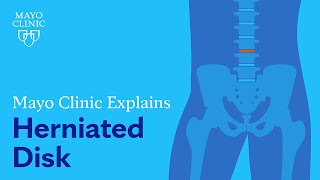 Mayo Clinic Explains Herniated Disk [upl. by Haakon]