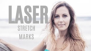 Howto Stretch Mark Removal With Laser Treatment [upl. by Ilellan95]