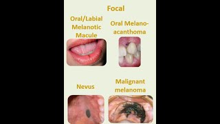 8 Focal melanosis [upl. by Pierrepont996]