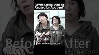 cervicaldystonia dystonia torticollis accident [upl. by Antonetta927]