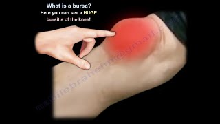 What Is BURSITIS  Everything You Need To Know  Dr Nabil Ebraheim [upl. by Rramo835]