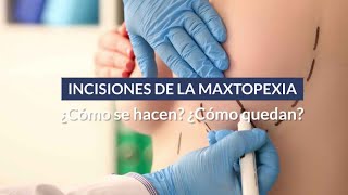 ¿Cómo son las cicatrices de una cirugia de mamas Incisiones de una Mastopexia [upl. by Strep]