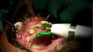 Estrazione di una radice dentale con Piezo Surgery [upl. by Waite]