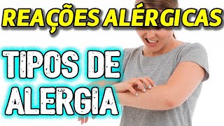 Reações Alérgicas  Diferentes tipos de alergia [upl. by Barlow]