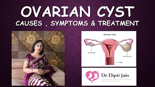 Ovarian cysts in women  Symptoms  Causes  Diagnosis  Treatment  Dr Rooma Sinha [upl. by Adnarem18]