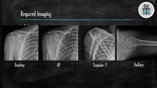 Proximal Humerus Fracture [upl. by Nahgeem]