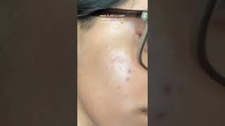 my 1 month tretinoin progress with acne prone skin [upl. by Innej941]