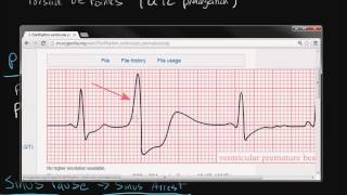 Electrocardiography Cardiac Arrhythmias [upl. by Aetnahs329]