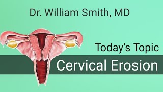 Cervical Erosion for Medical Students Cervical Ectropion [upl. by Atilamrac]