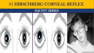 Phoria vs tropia  types of squint  Hirschberg Corneal Reflex Test HCRT  Squint series [upl. by Gnoht]