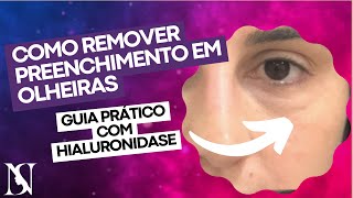 COMO REMOVER PREENCHIMENTO EM OLHEIRAS Guia Prático com Hialuronidase [upl. by Kilmarx]