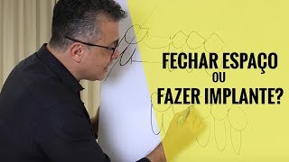 MESIALIZAÇÃO DE MOLARES  Fechar Espaço ou Fazer Implante  Comparação de métodos e medidas  Aula [upl. by Chally]