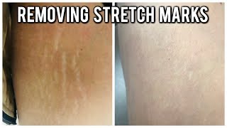 💝 REMOVING STRETCH MARKS 💝 [upl. by Ensign29]