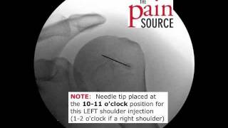 Glenohumeral Shoulder Injection under Fluoroscopic Guidance  ThePainSourcecom [upl. by Emelita]