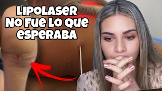 LASER LIPOLISIS FUNCIONA MI EXPERIENCIA PARTE 1 [upl. by Odnalref]