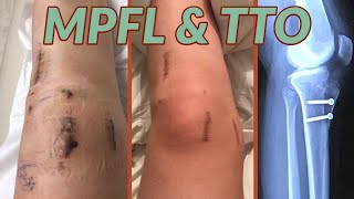 MPFL Reconstruction amp TTO 6Month Update  ft Bodyprox [upl. by Soirtemed15]