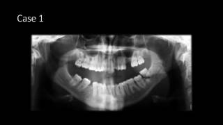 Mandible Fractures on Panoramic Radiographs [upl. by Necyla868]