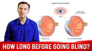 Diabetic Retinopathy Lecture and Diabetic Retinopathy Treatment  Diabetic Eye Exam [upl. by Doelling]