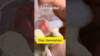 Disc tear and herniation model  explaining chronic lower back pain [upl. by Sheeree]