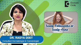 ACNE OR PIMPLES ON SCALP  Scalp Folliculitis  Causes amp Treatment DrRasya Dixit  Doctors Circle [upl. by Reinhard]