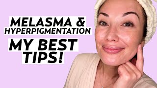 My Best Tips for Melasma amp HyperpigmentationProne Skin  Skincare with Susan Yara [upl. by Clements]