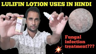 Lulifin lotion uses in hindi  Luliconazole Antifungal lotion uses in hondi How to use Lulifin [upl. by Nealon]