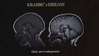 Imaging brain tumors  4  Other low grade gliomas [upl. by Nadbus512]