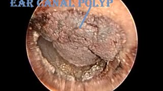 Otoendoscopic Dried Hemorrhagic Ear Canal Polyp Removal [upl. by Autumn]