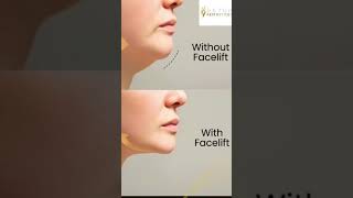 Non Surgical Facelift with HIFU technology skincare faceliftspecialist nonsurgicaltreatments [upl. by Naesal]